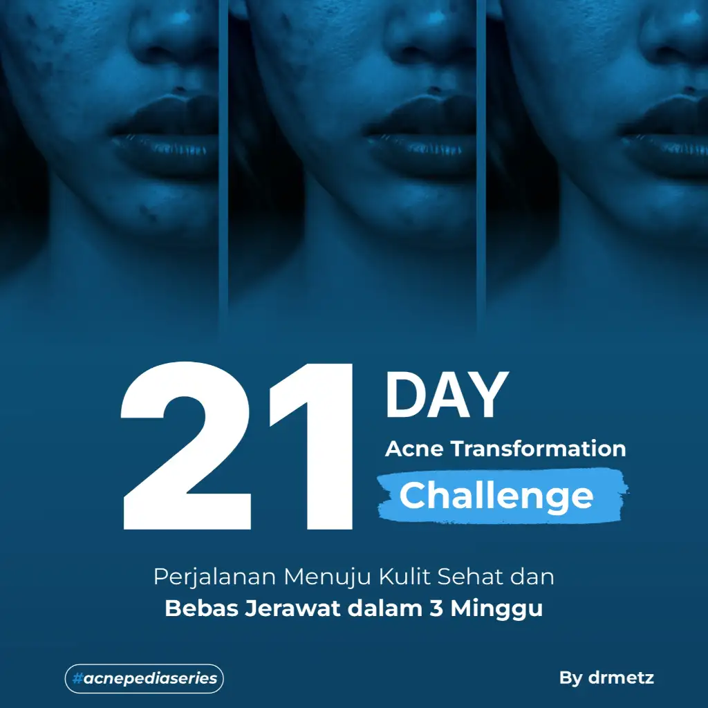Acne Challenge 21 Hari
